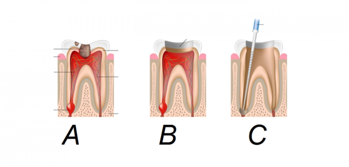 Chữa tủy răng tại quận 10